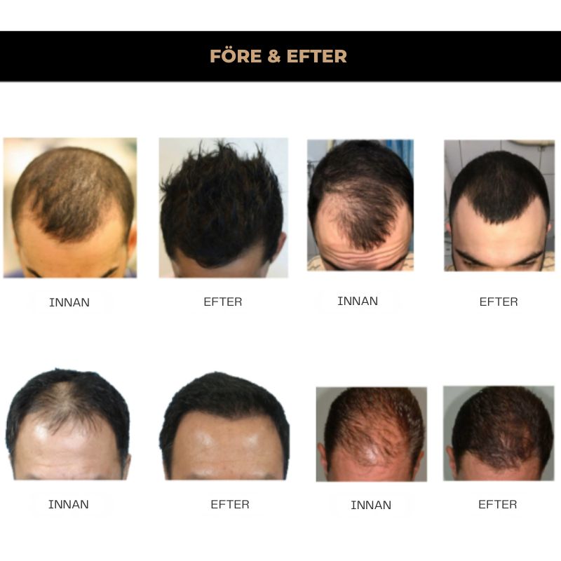 HairBoost™ | Inga kala fläckar längre!